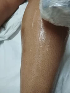 depilacao-laser-pernas-ibirite