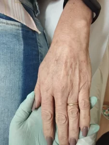 sardas-maos-remocao-laser-ibirite